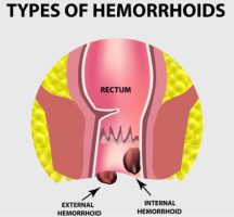 Ayurvedic treatment for haemorrhoids