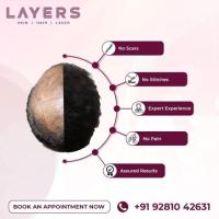 hair transplant surgeon in vijayawada