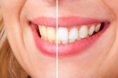 THE BENEFITS OF PROFESSIONAL TEETH WHITENING IN THANE