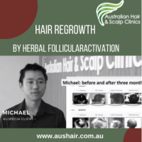 Regrow Hair Naturally with Our Professional Treatment