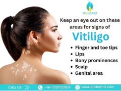 Effective Vitiligo Treatment in Hyderabad – Eudermiz Clinic