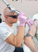 Choose The Premier Tattoo Removal Clinic in London