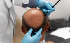  Free Natural looking Hair Transplant in Delhi