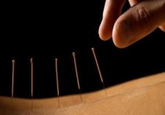 Relieve Stress and Pain with Acupuncture in Washington, DC