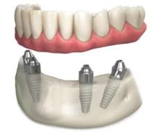 Dental Implants Melbourne Your Path to Oral Health