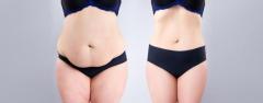 How Painful is a Tummy Tuck Surgery?