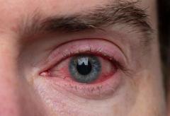 Red and Bloodshot Eyes: Causes & Treatment