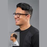 Men's Hair Restoration in Yorba Linda