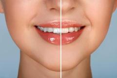 Brighten Your Smile with Ottawa Teeth Whitening