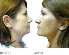 Face Lift Plastic Surgery – Expert Results at MyFaceSurgeon