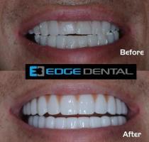 Laser Gum Depigmentation Near Me In Houston