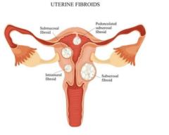 What Is Intramural Fibroid? Key Insights and Treatment Options