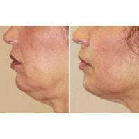 Forma Skin Tightening Cost