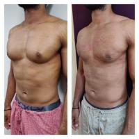 Gynecomastia Surgery in Delhi