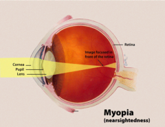 Myopia Management: Strategies for Clearer Vision