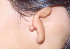 Ear Reshaping Surgery 