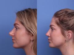 Rhinoplasty Surgery in Delhi