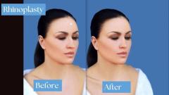 Best Rhinoplasty Surgery in Delhi 