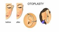 Best Otoplasty Surgery in Delhi - Dr Rajat Gupta