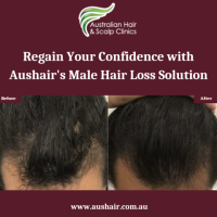 Regrow and Restore: Male Hair Loss Solutions in Melbourne