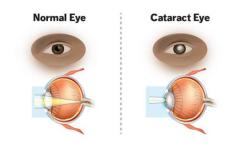 Cataract Eye Surgery in Delhi - Dr Anisha Gupta