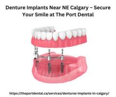 Denture Implants Near NE Calgary – Secure Your Smile at The Port Dental