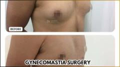 Gynecomastia Surgery In Bangalore