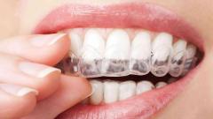 Invisalign in India: Cost, Benefits, and Factors Affecting the Price