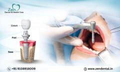 Best Dental Implant Treatment in Sarjapur Road Bangalore: Zen Dental Care 