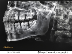 OPG Scan Price Affordable Dental Imaging Near You