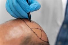 Fue Hair Transplant In Delhi