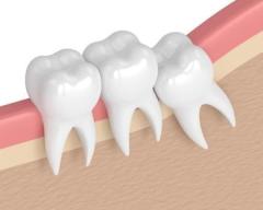 Wisdom Teeth in Melbourne: Safe, Expert Care for Impacted Teeth