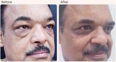 Blepharoplasty Surgery in Delhi - Dr Rajat Gupta