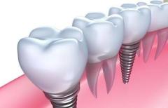 Digital Dental Implants in Sydney – Restore Your Smile with Confidence