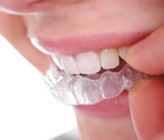 Digital Dental Implants in Sydney – Restore Your Smile with Confidence