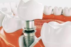 Wisdom Teeth Removal in Sydney: Expert Care for a Comfortable Recovery