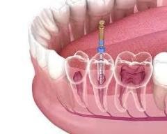 Looking for reliable root canal treatment in Calgary? 