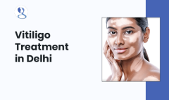 Vitiligo Treatment In Delhi - Mehektagul Dermaclinic