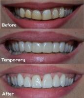 Zoom Teeth Whitening Services Near Me