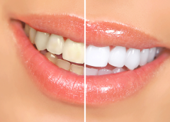 Teeth Whitening in Calgary | Brighten Your Smile with the Best Dental Care