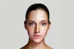 Pigmentation treatment in Delhi