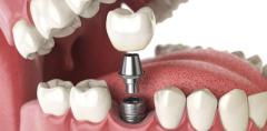 Everything You Need to Know About Tooth Implants in Chandigarh  