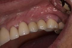 Dental implants Tijuana offers natural-looking and durable teeth replacements 