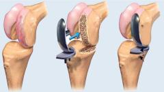 Knee Replacement surgeon in Noida