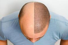 Best Hair Transplant Clinic in Varanasi - HAIR AESTHETICA