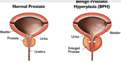 Effective Benign Prostate Hypertrophy Treatment