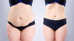 Best Tummy Tuck Surgery in Ahmedabad