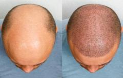 Best Hair Transplant Surgery in Ahmedabad