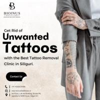 Get Rid of Unwanted Tattoos with the Best Tattoo Removal Clinic in Siliguri