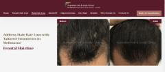 Address Male Hair Loss with Tailored Treatments in Melbourne